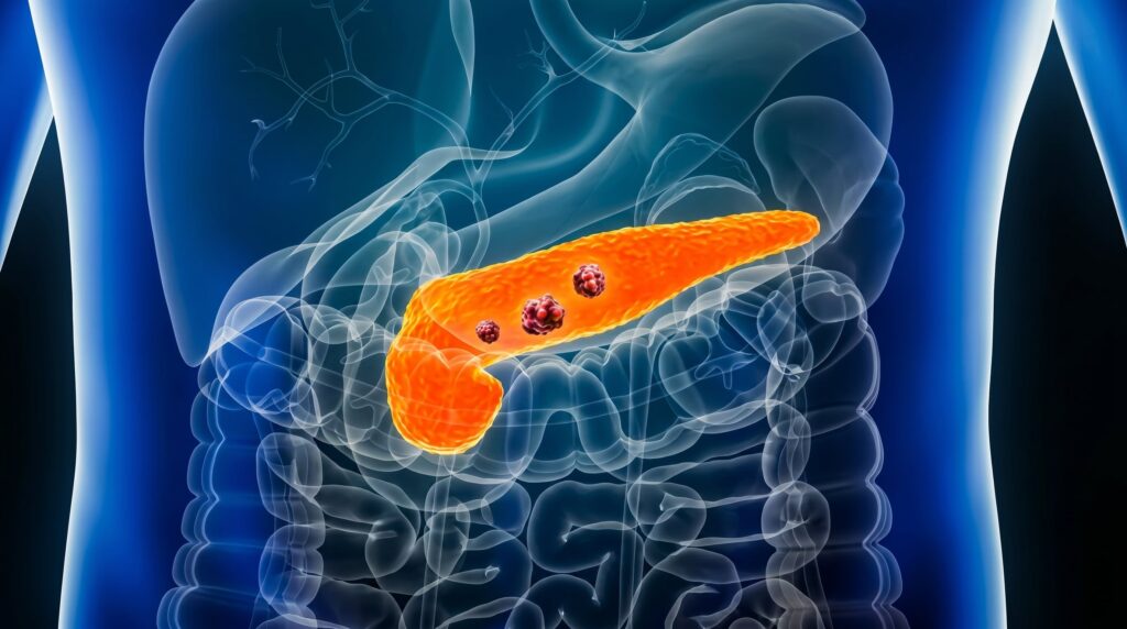 Imagen editorial relacionada con: Cáncer de páncreas: un nuevo fármaco experimental logra duplicar la supervivencia en pacientes metastásicos